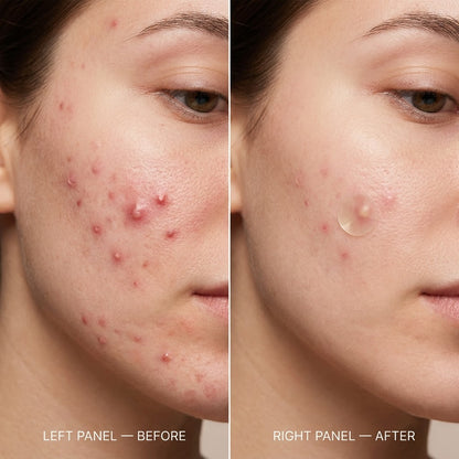 AuraShield™ Pimple Patch